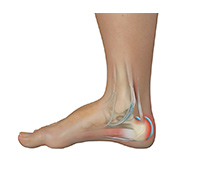 Achilles Tendon Bursitis