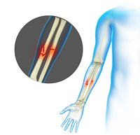 Adult Forearm Fractures