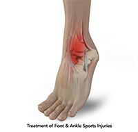 Ankle Injury