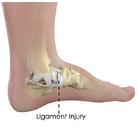 Ankle Ligament Injury