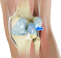 Baker’s Cyst