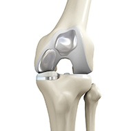 Bicompartmental Knee Resurfacing