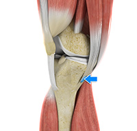 Bursitis