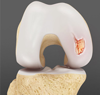 Chondral (Articular Cartilage Defects)