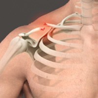 Clavicle Fracture