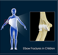 Elbow Fractures in Children