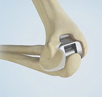 Elbow Joint Replacement