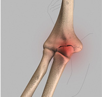 Elbow Pain