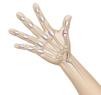 Finger and Thumb Sprain