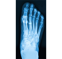 Foot Fracture