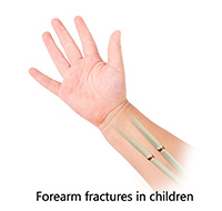 Forearms Fracture in Children