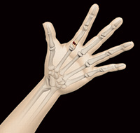 Fractures of the Hand and Fingers