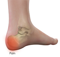 Heel Pain