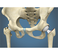 Hip Hemiarthroplasty