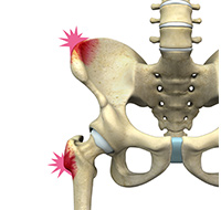 Hip Pointers