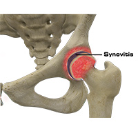 Hip Synovitis