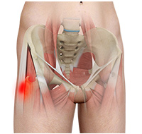 Hip Tendonitis