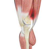 Iliotibial Band Syndrome