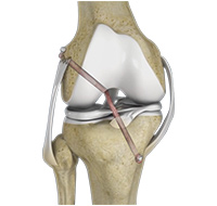 Knee Ligament Reconstruction