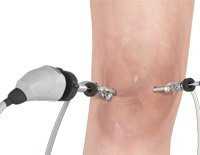 Knee Arthroscopy