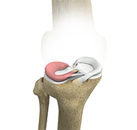 Lateral Meniscus Syndrome