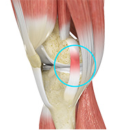 MCL Sprain