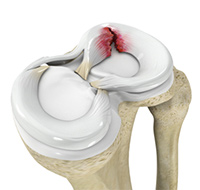 Medial Meniscus Syndrome