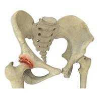 Osteoarthritis of the Hip