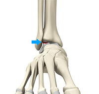 Osteochondral Injuries of the Ankle