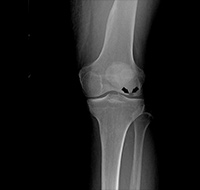 Osteonecrosis of the Knee