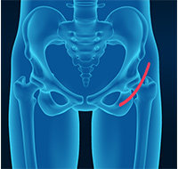 Outpatient Hip Replacement