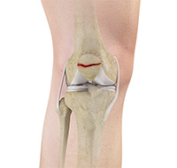 Patella Fracture