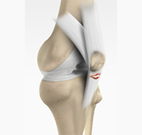 Patella Tendon Rupture