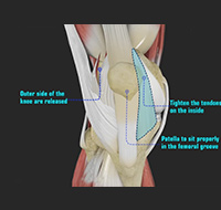 Patellar Instability