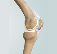 Patellar Tendinitis