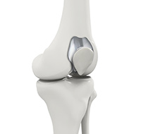 Patellofemoral Knee Replacement