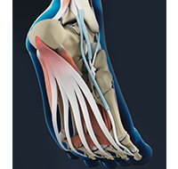 Plantar Fasciitis