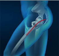 Posterior Hip Replacement