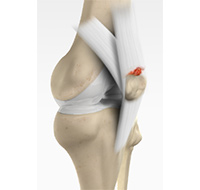 Quadriceps Tendon Rupture