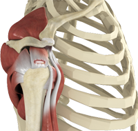 Rotator Cuff Tear