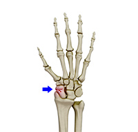 Scaphoid Fracture