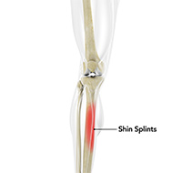 Shin Splints