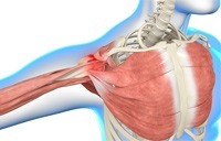 Shoulder Impingement