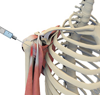 Shoulder Injections