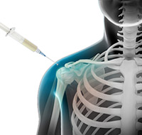 Shoulder Injections