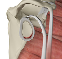 Shoulder Joint Tear