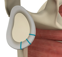 Shoulder Labrum Reconstruction