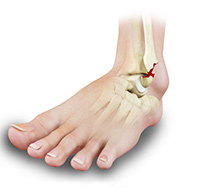 Stress Fracture of the Foot