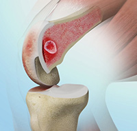 Subchondroplasty