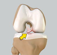 Tibial Eminence Spine Avulsions